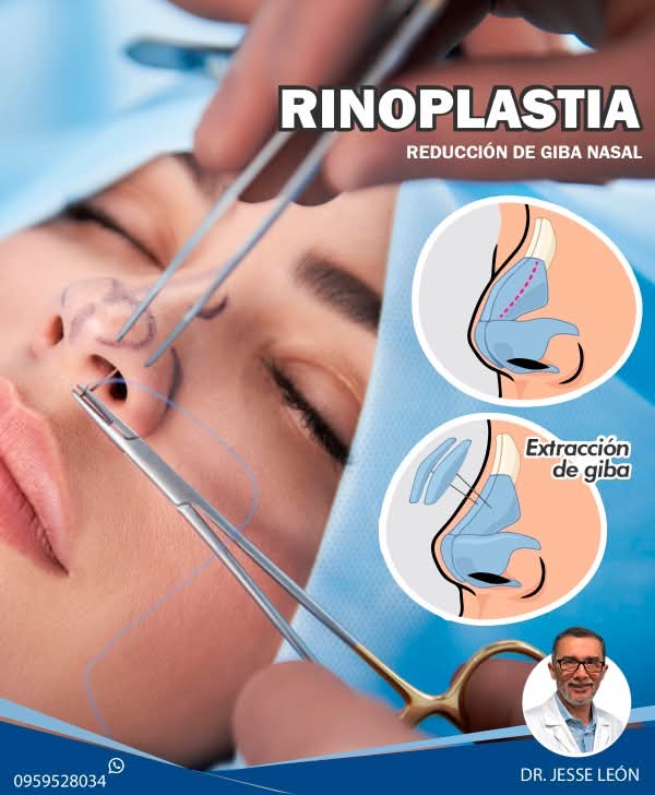 Rinoplastia — reducción de giba nasal